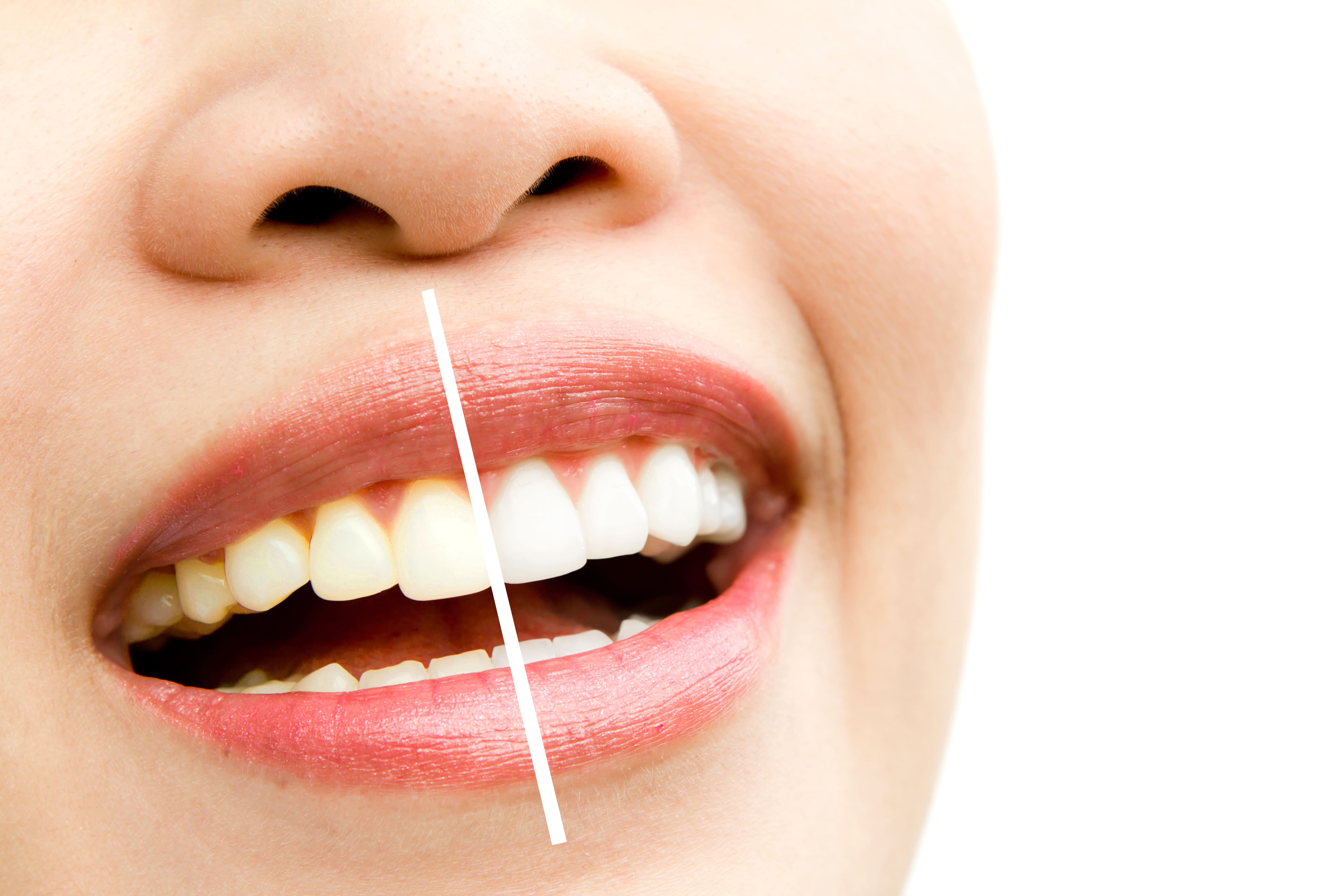 Teeth Whitening and Teeth Bleaching