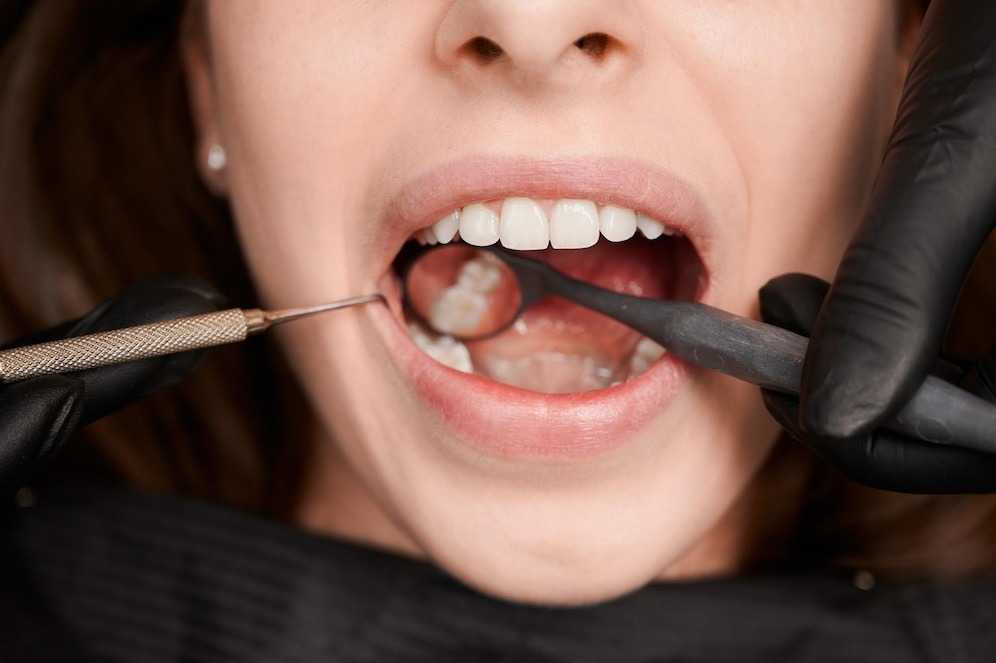 Dental erosion prevention